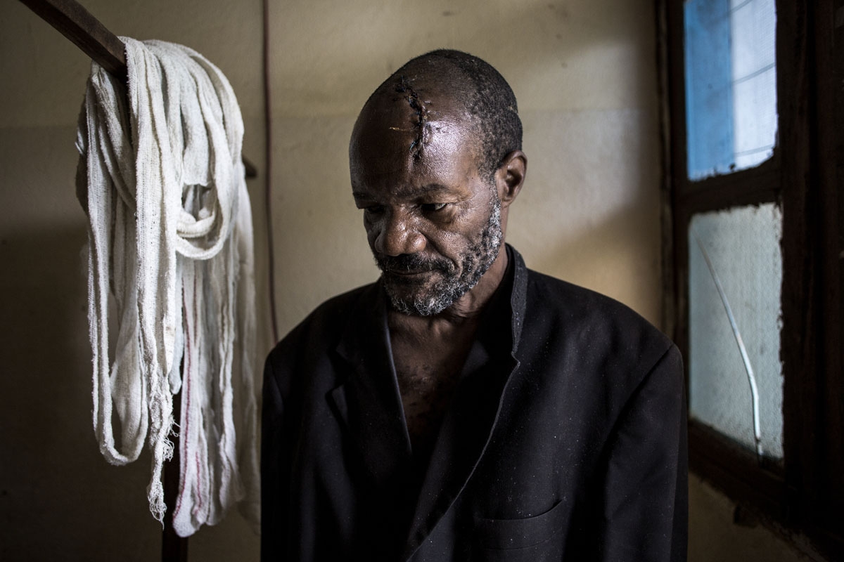 Bawma Yoame, 56, recovers in a hospital room on March 2, 2018 in Bunia, after an attack on his village in the region of Ituria left him severely wounded with multiple lacerations to his head. Mojetha hid in the bush for two nights before reaching Bunia to