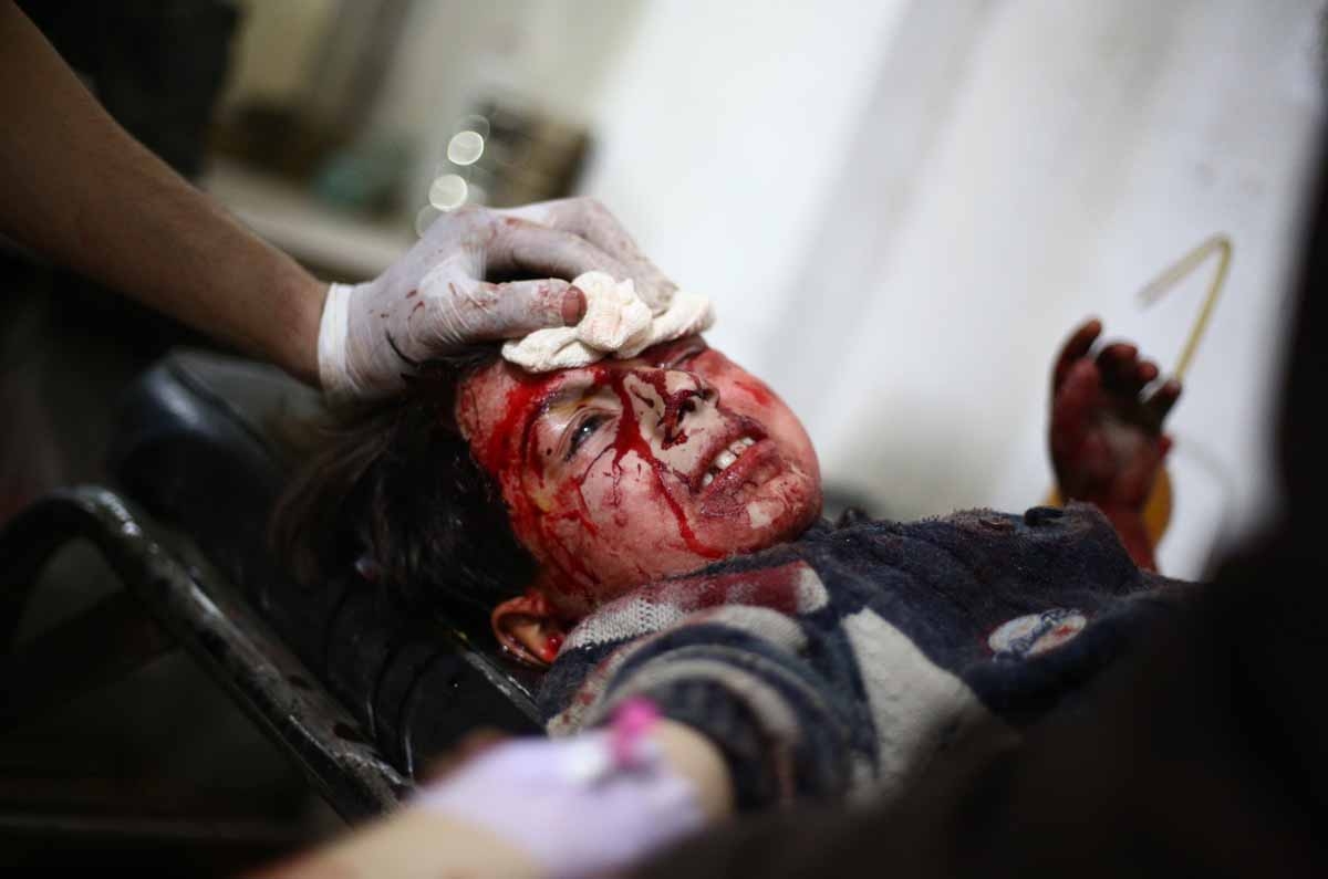 A wounded Syrian child receives medical treatment at a make-shift clinic in the rebel-held area of Douma, east of the capital Damascus, following reported air strikes by government forces on March 15, 2015. A wounded Syrian child receives medical treatment at a make-shift clinic in the rebel-held area of Douma, east of the capital Damascus, following reported air strikes by government forces on March 15, 2015.