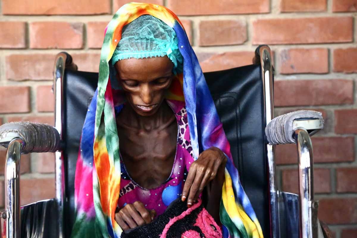 18-year-old Yemeni woman from an impoverished coastal village on the outskirts of the rebel-held Yemeni port city of Hodeida, where malnutrition has hit the population hard, sits in a wheelchair at the al-Thawra hospital in Hodeidah where she is receiving